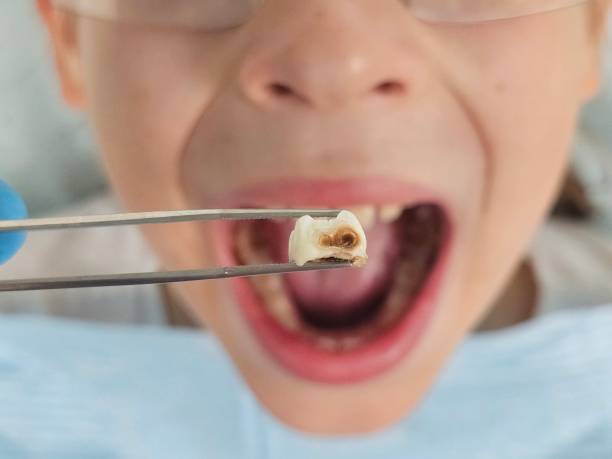 Best Emergency Dentist for Knocked-Out Tooth in Pensacola, FL